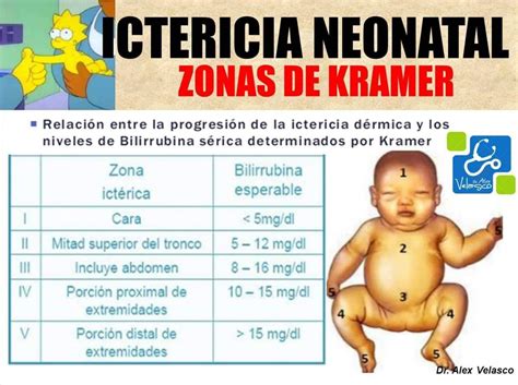 Tabla de progresión de la ictericia según la zona corporal y los niveles estimados de bilirrubina.