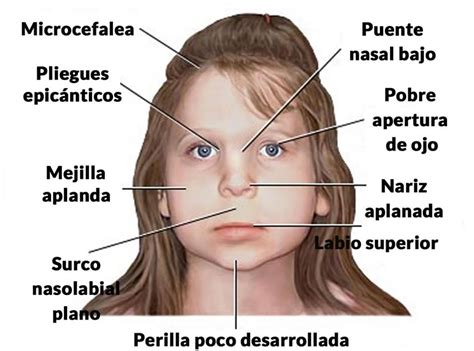Ilustración detallada de los rasgos faciales típicos asociados al síndrome alcohólico fetal.