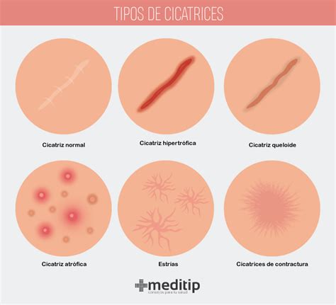 Infografía comparativa mostrando la evolución de una cicatriz sana frente a una cicatriz queloide.