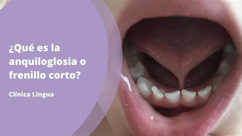 Esquema anatómico mostrando la diferencia entre un frenillo lingual normal y uno corto (anquiloglosia) que limita el movimiento.