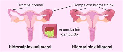 Esquema anatómico que muestra una trompa de Falopio con hidrosalpinx (dilatada y llena de líquido) comparada con una trompa sana.