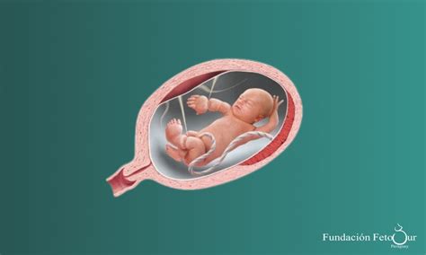 Esquema ilustrativo del mecanismo de atrapamiento por bandas amnióticas durante el desarrollo fetal