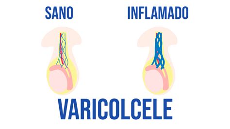Ilustración anatómica del varicocele, mostrando la dilatación de las venas del cordón espermático y la acumulación de sangre en el plexo pampiniforme.