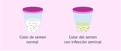 Infografía comparativa: diferencias entre un semen con consistencia normal y un semen con posibles alteraciones (grumos, cambios de color).