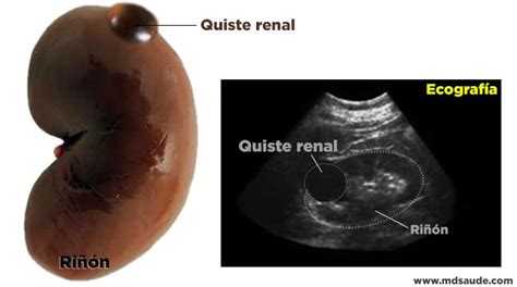 Infografía comparando quiste renal simple y complejo con septos.