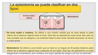 Esquema de tipos de episiotomía: incisión de línea media y mediolateral