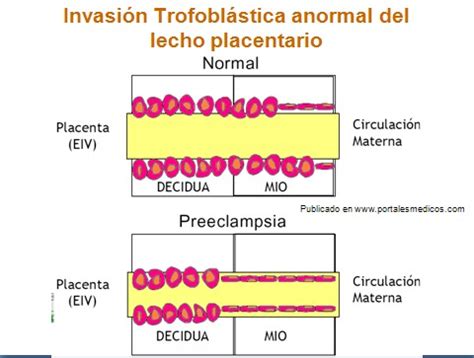 Esquema del desarrollo placentario normal y anormal en preeclampsia