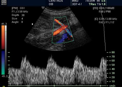 Ecografía Doppler de la arteria uterina mostrando el índice de pulsatilidad