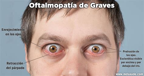 Foto de ojos con exoftalmos característicos de la enfermedad de Graves