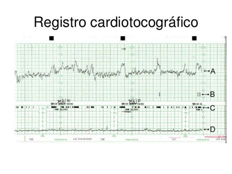Infografía o esquema de un partograma o registro cardiotocográfico fetal