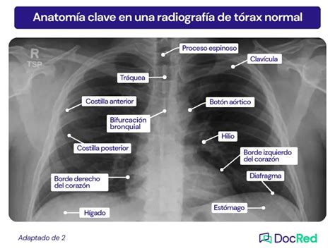 esquema o foto de una radiografía de tórax con signos de neumonía