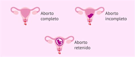 Diagrama comparativo de los dos métodos de aborto con pastillas, mostrando esquemas de tratamiento