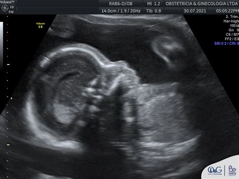Ecografía fetal 3D mostrando el perfil facial