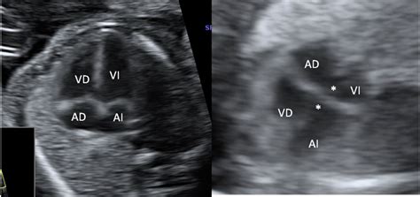Ecografía fetal mostrando el corazón de un bebé