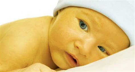 Bebé con coloración amarillenta de la piel por ictericia neonatal