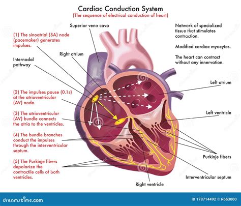Diagrama esquemático del sistema de conducción cardíaca y posibles puntos de bloqueo.