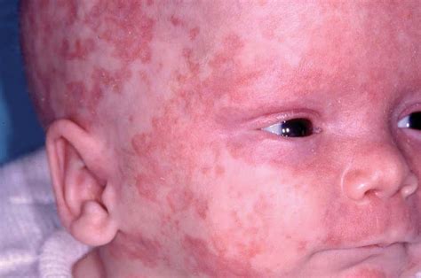 Ilustración de un bebé con eritema periocular característico del lupus eritematoso neonatal.