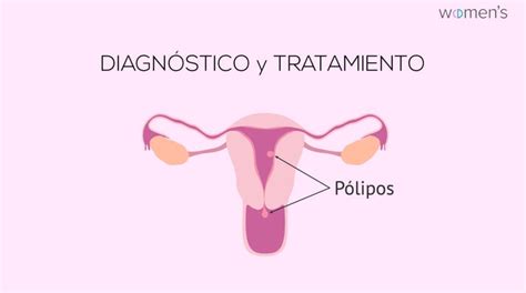 Esquema del útero con un pólipo endometrial