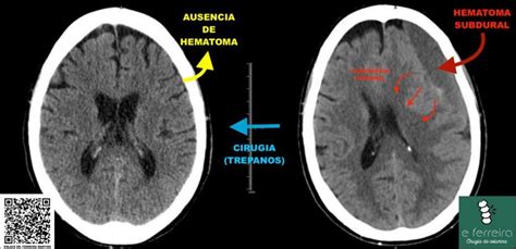 Ejemplo de TAC cerebral mostrando hematomas subdurales en un lactante
