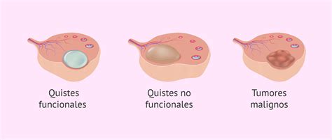 Infografía detallando los posibles síntomas de un quiste ovárico.