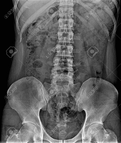 Imagen de una radiografía o esquema de la región caudal humana con una cola vestigial
