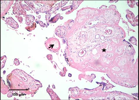 Microfotografía de vellosidades placentarias con cambios isquémicos