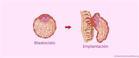 Diagrama del blastocisto implantándose en el endometrio uterino