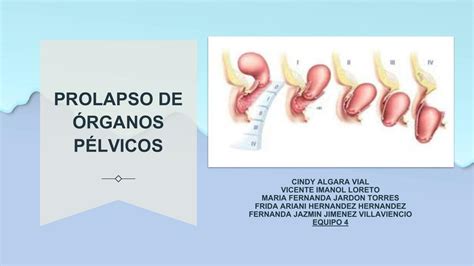 Infografía ilustrando los diferentes tipos de prolapso de órganos pélvicos