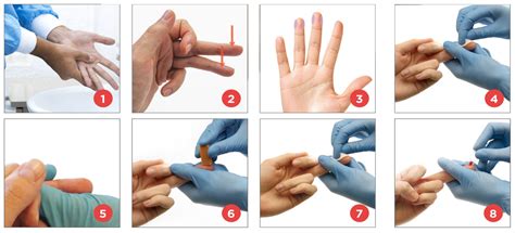 Ilustración del procedimiento de punción del talón para la obtención de muestras de sangre capilar para cribado neonatal.