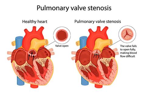Esquema anatómico de la estenosis valvular pulmonar: comparación entre la válvula estenótica y el procedimiento de comisurotomía valvular para su apertura.