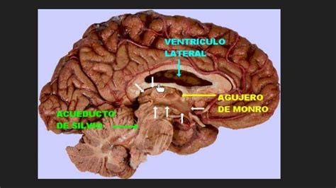 Angiograma del ventrículo derecho en posición lateral mostrando la cintura característica producida por la válvula pulmonar estenótica.