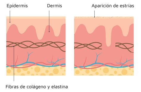 Ilustración del proceso de formación de estrías en la piel.