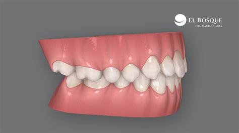Diagrama dental: Comparación de una mordida correcta y una mordida abierta anterior