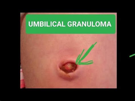 Ilustración de un bebé con un granuloma umbilical, mostrando su aspecto carnoso y rojizo.