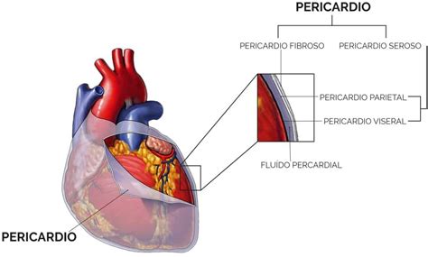Esquema anatómico del corazón rodeado por el pericardio mostrando la acumulación de líquido (derrame pericárdico) entre las capas visceral y parietal.