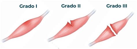 Infografía comparativa que muestra los cuatro grados de desgarros perineales y las zonas musculares afectadas.