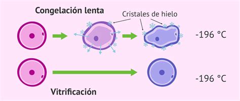 Esquema comparativo entre la congelación lenta tradicional y la técnica de vitrificación ultrarrápida.