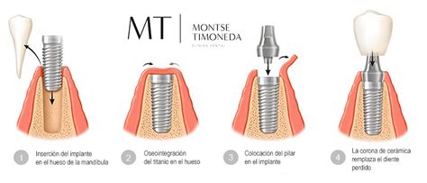 Esquema anatómico mostrando la colocación de implantes retromusculares frente a los retroglandulares y su relación con los conductos galactóforos.