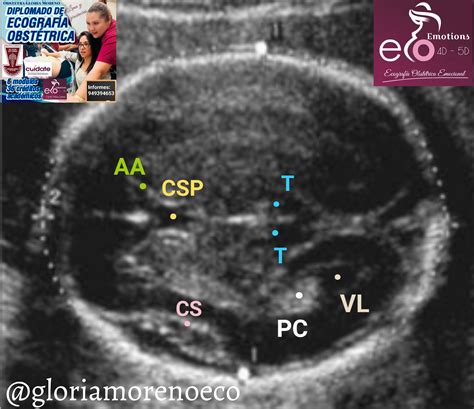 Ecografía fetal mostrando cortes cardíacos
