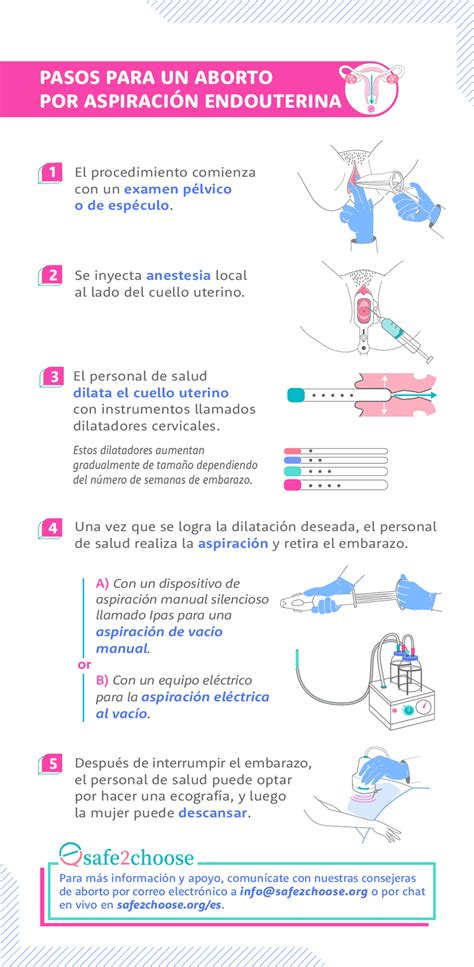 Esquema detallado del procedimiento de aborto por aspiración mostrando la cánula y el sistema de succión