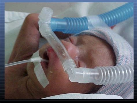 Representación gráfica de la aplicación de CPAP nasal en un recién nacido.