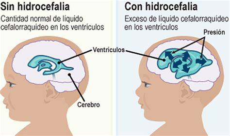 Ilustración clínica mostrando los signos físicos de la hidrocefalia en un lactante.