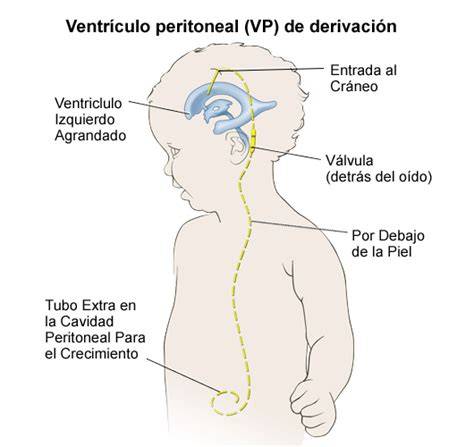 Esquema que ilustra el funcionamiento de una derivación ventriculoperitoneal.