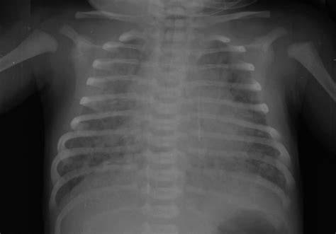 Radiografía de tórax de un recién nacido con síndrome de dificultad respiratoria