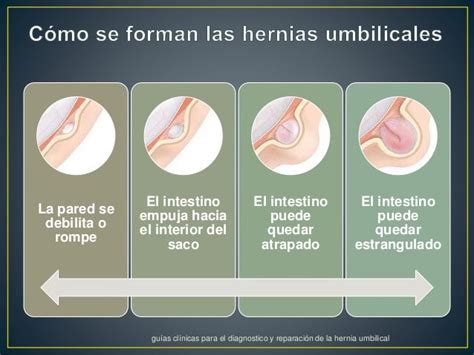 Representación esquemática de una hernia umbilical en un bebé, mostrando la protrusión de tejido a través de la pared abdominal cerca del ombligo.