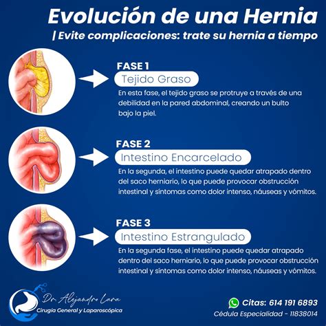 Diagrama que ilustra las complicaciones de una hernia: incarceración y estrangulamiento, con énfasis en la reducción del flujo sanguíneo.