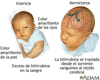 Ilustración de un bebé con ictericia y signos de kernícterus (opistótonos)