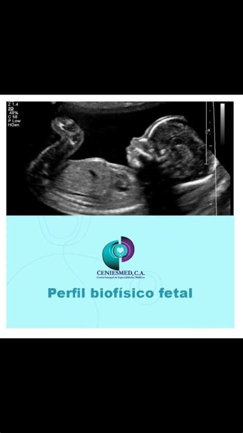 Imagen de una ecografía mostrando el perfil biofísico fetal