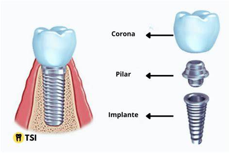 Esquema de un implante dental y los tejidos que lo rodean (encía y hueso)
