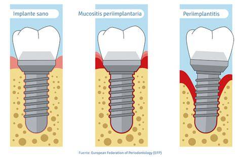 Comparativa entre encía sana, mucositis periimplantaria y periimplantitis